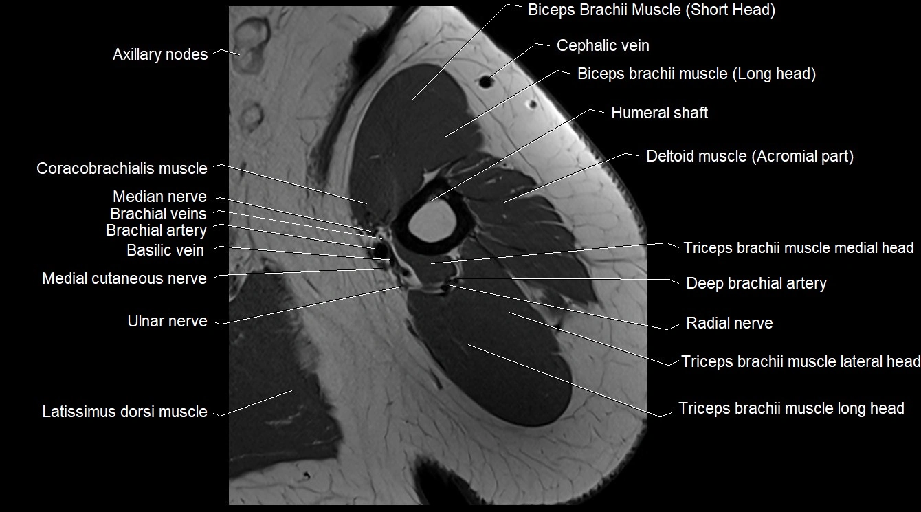 Upper arm( humerus) cross section anatomy MRI 3T axial image 26.webp
